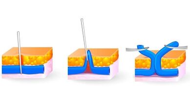 Flebectomie comme méthode pour le traitement des varices