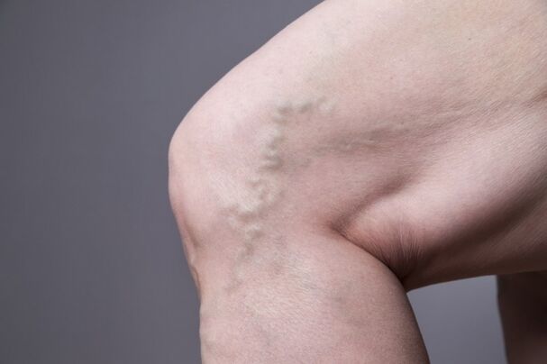 Les varices chez la femme