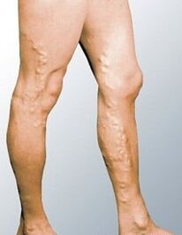 Varices dans les jambes d'un homme
