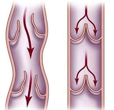 Varices