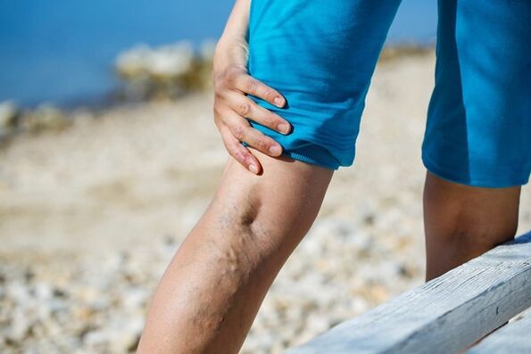 Douleur lancinante dans les jambes avec varices