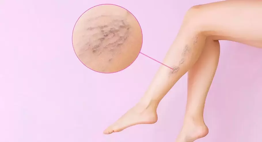 Veines bombées tortueuses sur les jambes avec varices