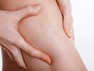 douleur aux jambes avec varices